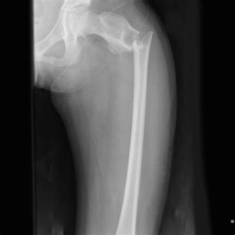 Procedure Of X Ray Femur Aplateral View Ganesh Diagnosic