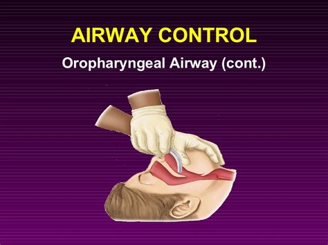 Airway Adjuncts And Management In Acls