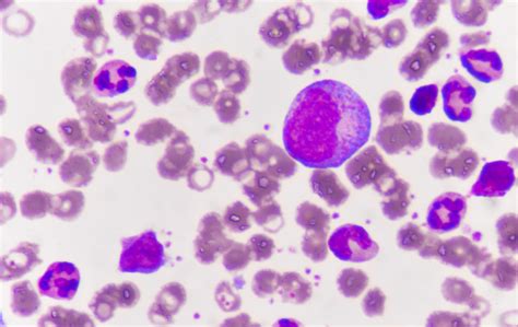 Chronic Myeloid Leukemia What Your Patients Need To Know Cancer