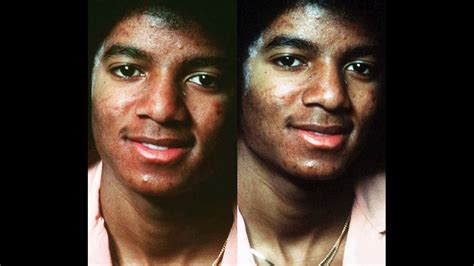 Vitiligo Michael Jackson Proof