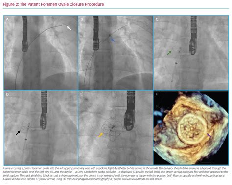 The Patent Foramen Ovale Closure Procedure Radcliffe Cardiology