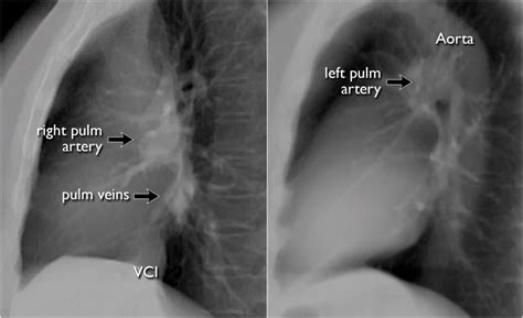 Anatomy Clinical Radiology Cxr Lateral Vasculature Grepmed