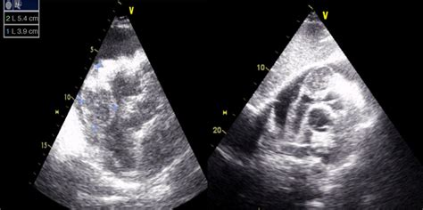 Two Dimensional Transthoracic Echocardiography In Subcostal View