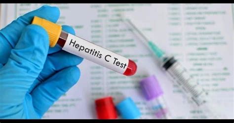 Hay Tratamiento Gratuito Contra La Hepatitis C Diagnostico Medico