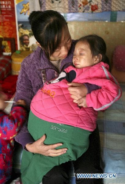 Girl At 4 Has Swollen Belly Due To Unknown Disease Peoples Daily Online