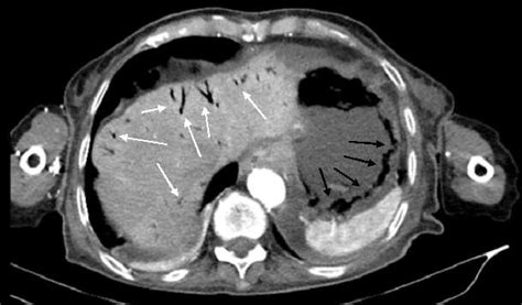 An Axial Contrast Enhanced Computed Tomography Of The Abdomen Showing