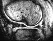 La Radiologia del ginocchio
