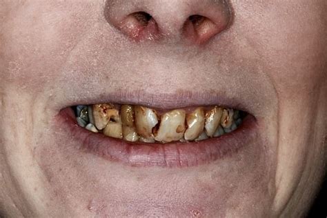 Woman 26 Told She Would Need Full Dentures To Fix Her Decaying Teeth