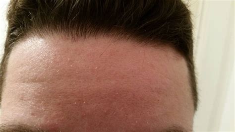 Skin Rash On Forehead Pictures Photos