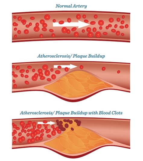 Atherosclerosis Mens Health Resource Center