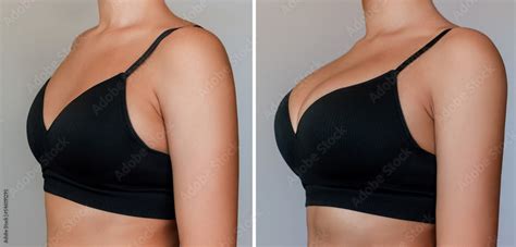 Young Tanned Woman In Bra Before And After Breast Augmentation With