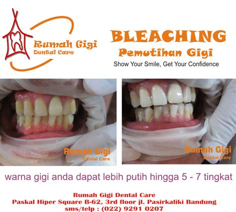 Dokter Gigi Bandung Bagus Rumah Gigi Dental Care
