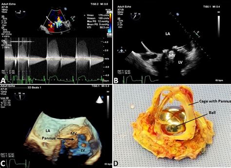 Diagnostic Value Of Three Dimensional Echocardiography For The