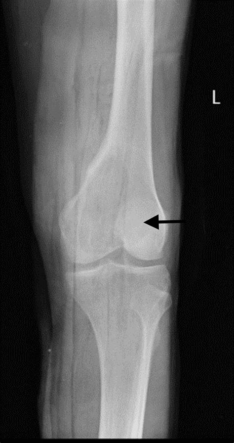 Cureus Osteosarcoma Of The Distal Femur Presenting As Giant Cell