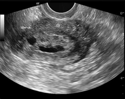 It's unusual for endometrial tissue to spread beyond your pelvic region, but it's not impossible. Endometrial hyperplasia | Radiology Reference Article ...