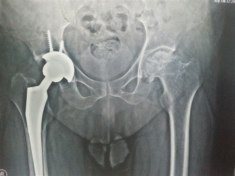 Femur Bone Fracture Surgery