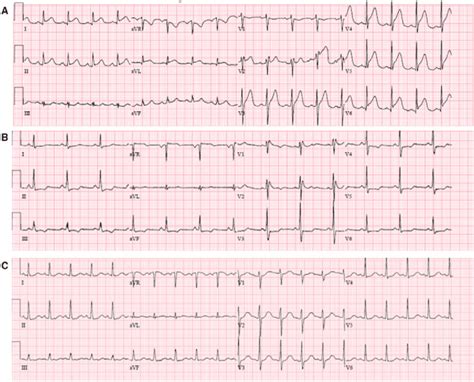 A Ecg On Day 1 Shows Diffuse St Elevation And Pr Depression In