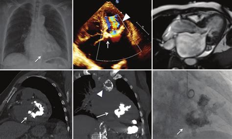 Multimodality Imaging Of Severe Coralliform Mitral Stenosis And
