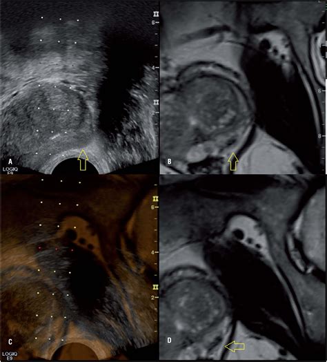 Multi Parametric Mri Mpmri In Prostate Cancer Diagnosis Prostate