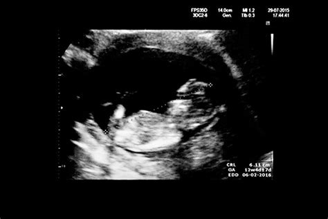 The nuchal translucency scan (also called the nt scan) uses ultrasound to assess your developing baby's risk of having down syndrome (ds) and some other chromosomal abnormalities, as well as major congenital heart problems. 12-week pregnancy dating scan: what will it tell me ...