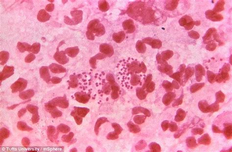 Antibiotic Resistant Gonorrhea Is Four Times More Common In Men Daily