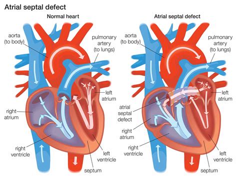 Atrial Septal Defect Asd Explained