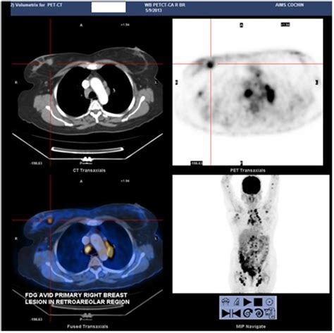 Pet Ct Image Showing Fdg Avid Axillary Cervical Mediastinal And