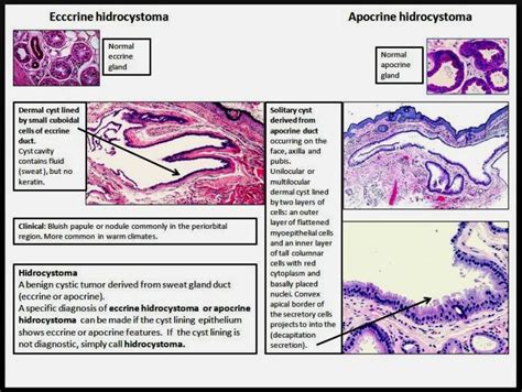 Eccrine And Apocrine Hidrocystoma Dr Sarmas Dermpath And Other Pathology