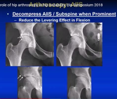 Hip Arthroscopy To Treat Instability Orthopaedicprinciples Com