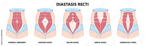 Diastasis Recti Six Pack Separation Belly Rectus Linea Alba Abdominal