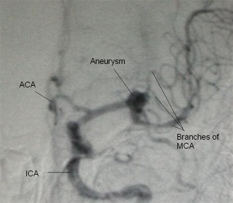 Middle Cerebral Artery Aneurysm