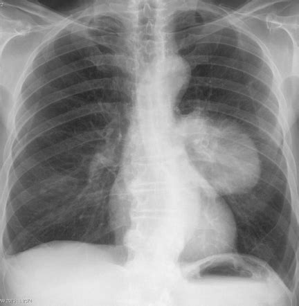 Lung Cancer Radiology Case Radiopaedia Org