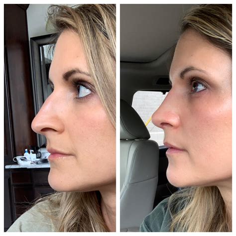 Rhinoplasty Before And Exactly One Month Post Op 38f Surgery In Texas