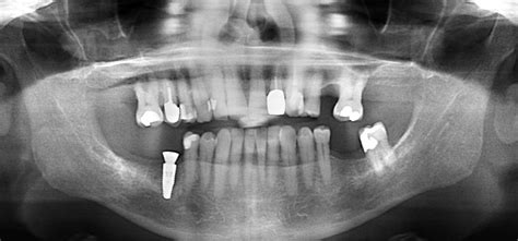 Dental Implants David C Stahr Dds Oral Surgery — Stahr Oral Surgery