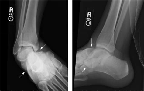 Ankle Dislocation Xray