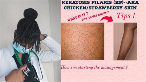How To Get Rid Of Chicken Skin Keratosis Pilaris Skincareroutine
