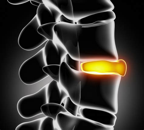 Bulging Disc Treatment Carl Spivak Md Executive Spine Surgery