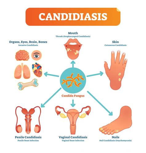 Aplicado Bisagra Aleación Candida Albicans Vaginal Sintomas Entretener