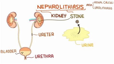 Nephrolithiasis Kidney Stone Youtube