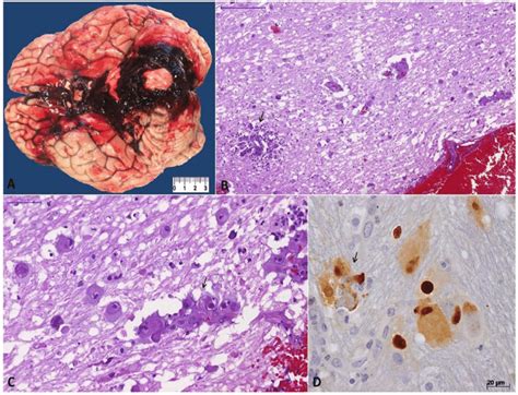 Cytomegalovirus Cmv Encephalitis A Gross View Showing Subarachnoid