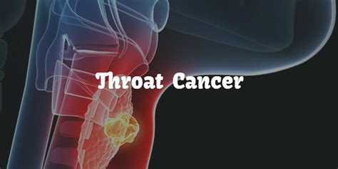 What Is Throat Cancer Causes Symptoms Treatment Of Throat Cancer