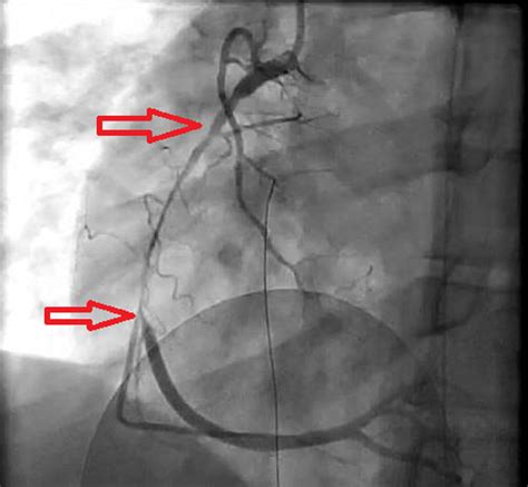 Cureus Traumatic Right Coronary Artery Dissection As A Cause Of