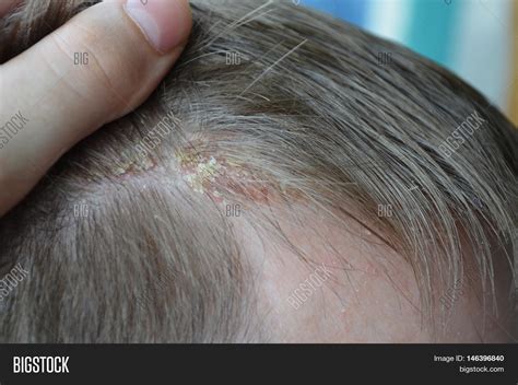 Psoriasis On Hairline Image And Photo Free Trial Bigstock