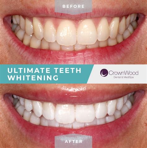 Awesome Ultimate Teeth Whitening Beforeafter Crownwood Dental