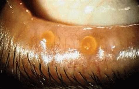 Blepharitis And Inflammation Of The Eyelids Ento Key