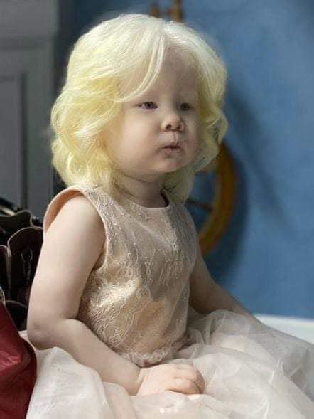 Albino Girl Stuns The World With Santa Claus Magic Story