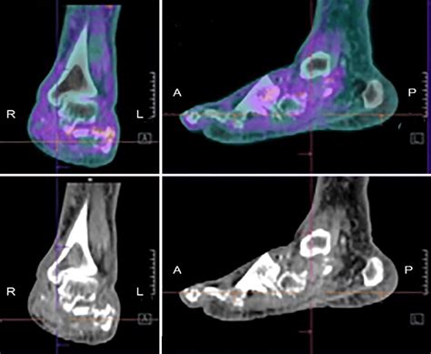 Example Of 18 F Fdg Petct In A Patient With Charcot Download