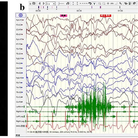 Brain Magnetic Resonance Imaging Mri And Electroencephalogram Eeg Download Scientific