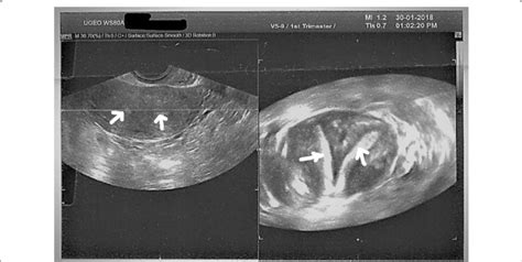 3d Ultrasound Of Uterus Didelphys In Our Clinical Case At The Time Of
