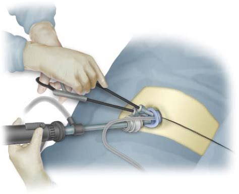 Single Incision Laparoscopic Surgery Total Extraperitoneal Inguinal